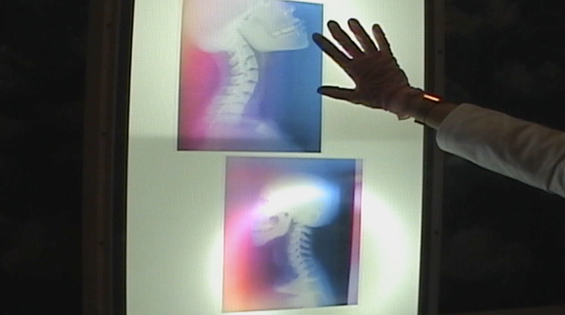 Still from a camcorder video showing two colorful pseudomedical images of the upper cervical region displayed on a vintage X-ray viewer lightbox. The arm of a medical professional in a lab coat and pink exam gloves extends toward the images.